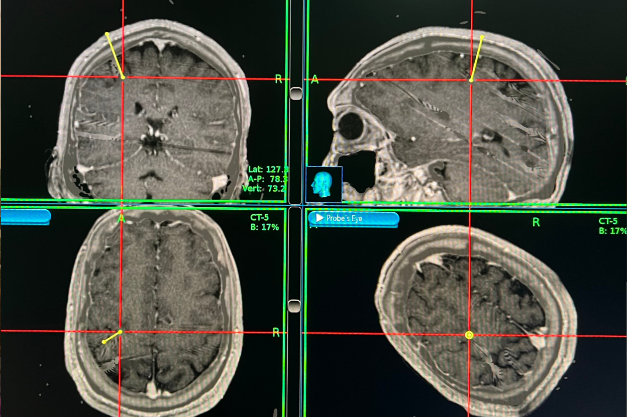 Procedimiento realizado en Instituto de Neurocirugía abre la opción de cirugía a un paciente con epilepsia refractaria